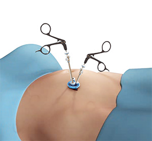 laparoscopic tubal ligation scars